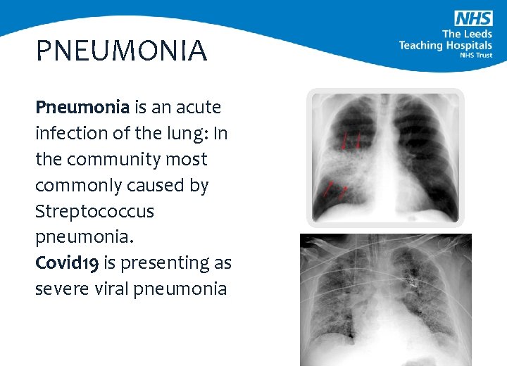 PNEUMONIA Pneumonia is an acute infection of the lung: In the community most commonly