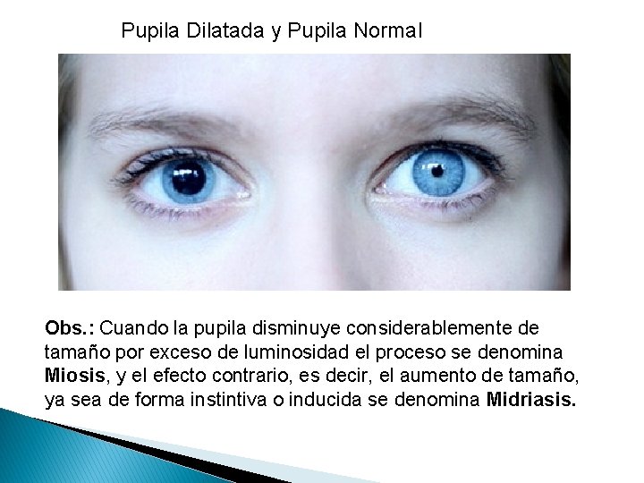 Pupila Dilatada y Pupila Normal Obs. : Cuando la pupila disminuye considerablemente de tamaño