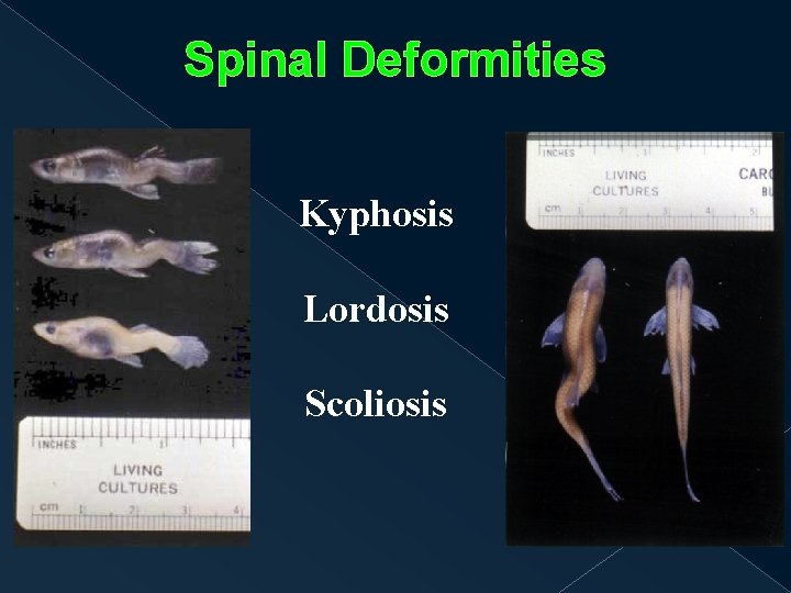 Spinal Deformities Kyphosis Lordosis Scoliosis 