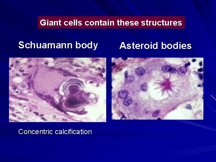 Giant cells contain these structures Schuamann body Concentric calcification Asteroid bodies 