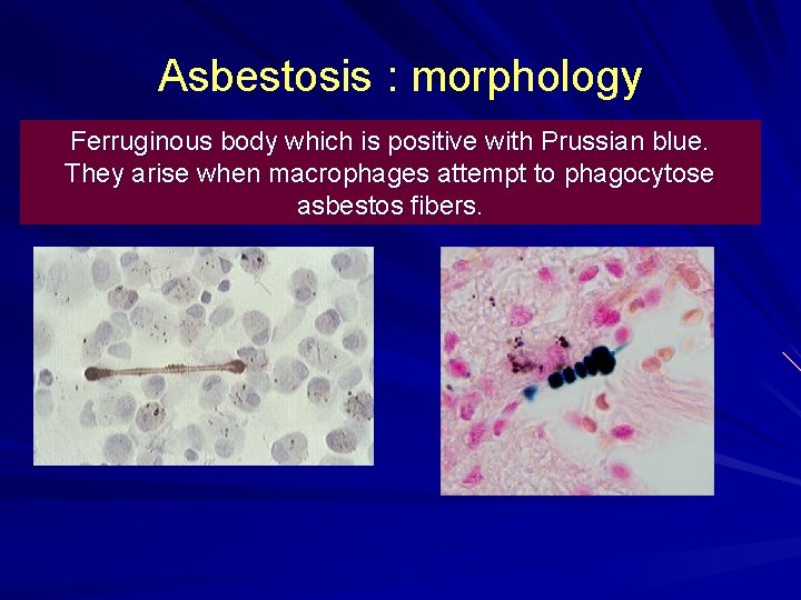 Asbestosis : morphology Ferruginous body which is positive with Prussian blue. They arise when