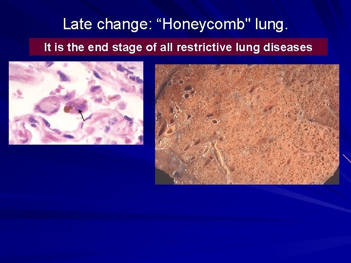 Late change: “Honeycomb" lung. It is the end stage of all restrictive lung diseases Late change: “Honeycomb" lung. It is the end stage of all restrictive lung diseases
