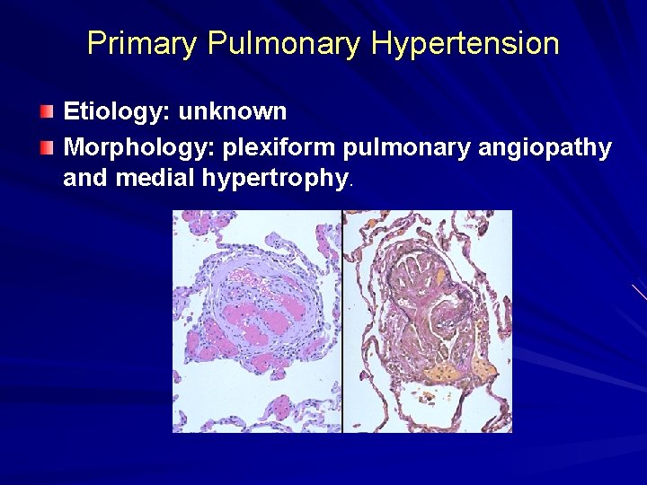 Primary Pulmonary Hypertension Etiology: unknown Morphology: plexiform pulmonary angiopathy and medial hypertrophy. 