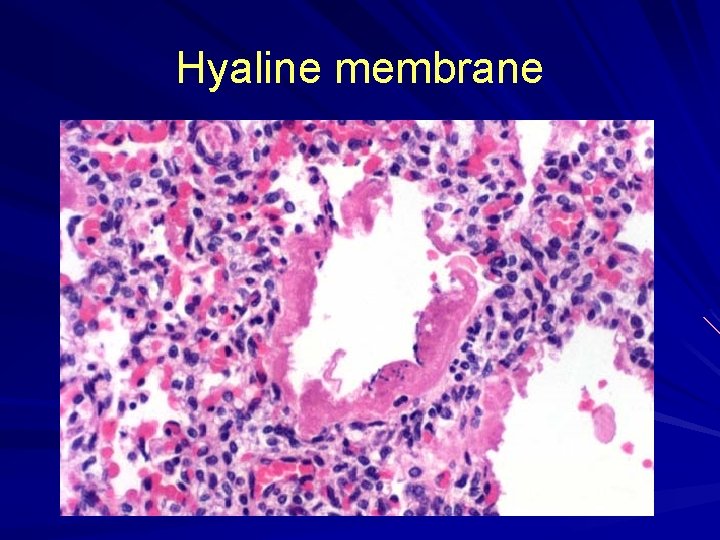 Hyaline membrane 