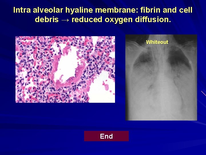 Intra alveolar hyaline membrane: fibrin and cell debris → reduced oxygen diffusion. Whiteout End Intra alveolar hyaline membrane: fibrin and cell debris → reduced oxygen diffusion. Whiteout End