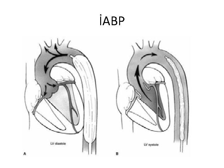 İABP 