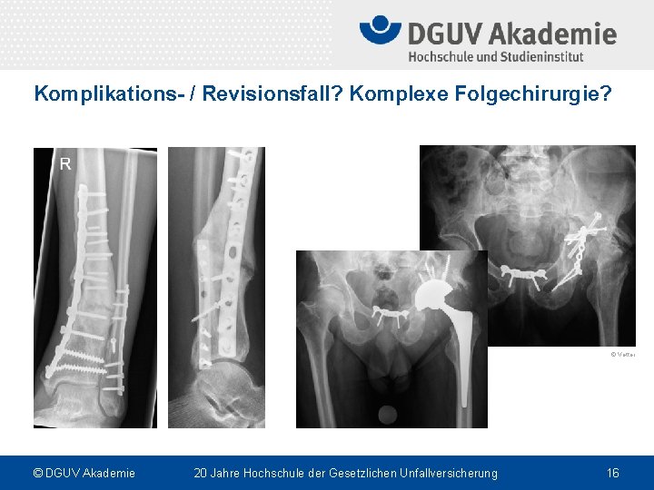 Komplikations- / Revisionsfall? Komplexe Folgechirurgie? © Vetter © DGUV Akademie 20 Jahre Hochschule der