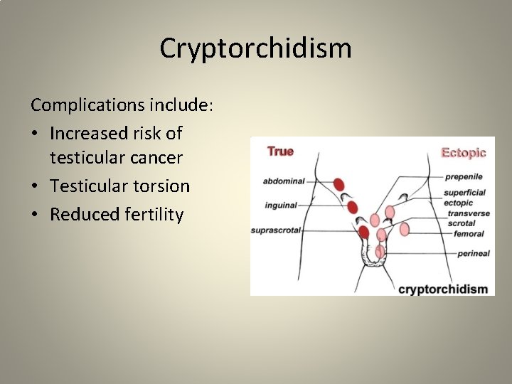Cryptorchidism Complications include: • Increased risk of testicular cancer • Testicular torsion • Reduced
