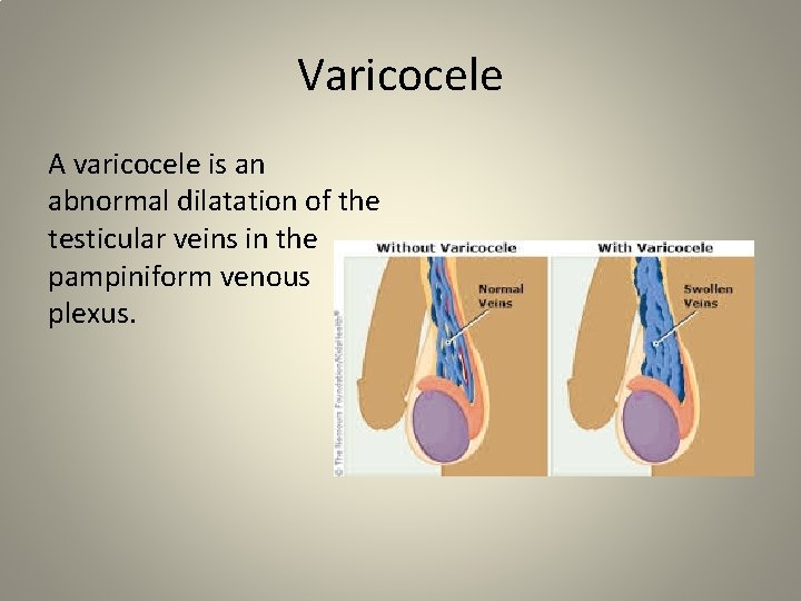 Varicocele A varicocele is an abnormal dilatation of the testicular veins in the pampiniform