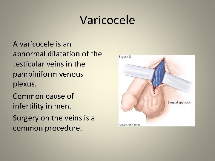 Varicocele A varicocele is an abnormal dilatation of the testicular veins in the pampiniform