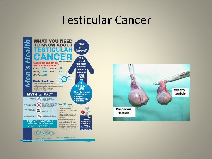 Testicular Cancer 