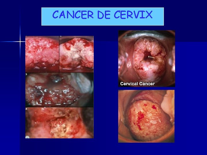 CANCER DE CERVIX 