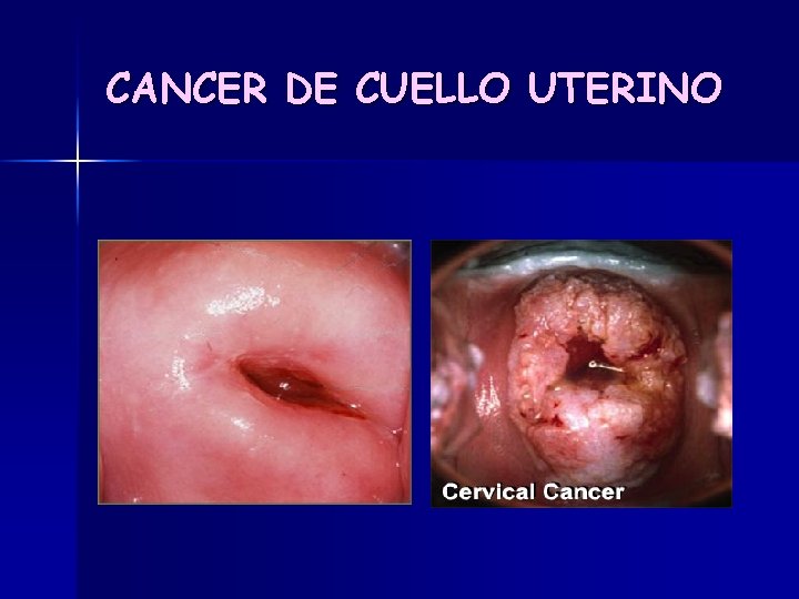 CANCER DE CUELLO UTERINO 