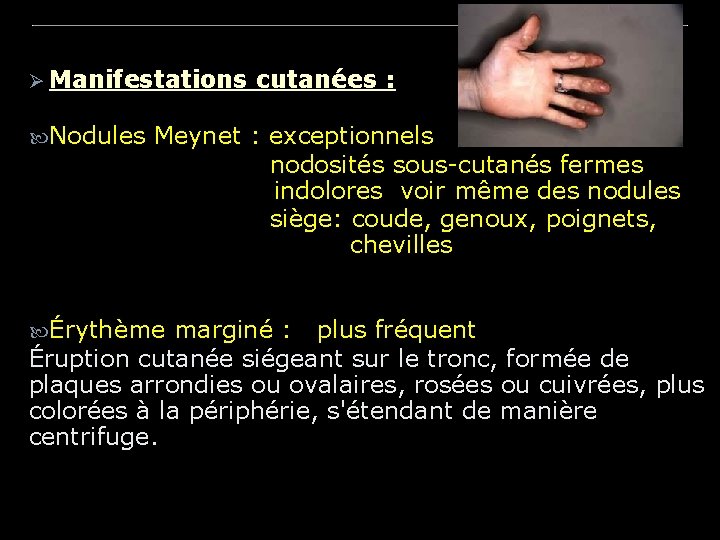 Ø Manifestations Nodules cutanées : Meynet : exceptionnels nodosités sous-cutanés fermes indolores voir même