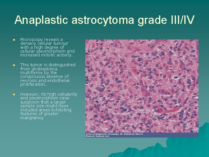 Anaplastic astrocytoma grade III/IV u Microscopy reveals a densely cellular tumour with a high