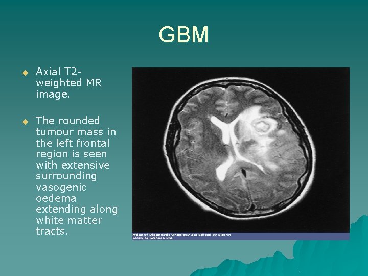GBM u Axial T 2 weighted MR image. u The rounded tumour mass in