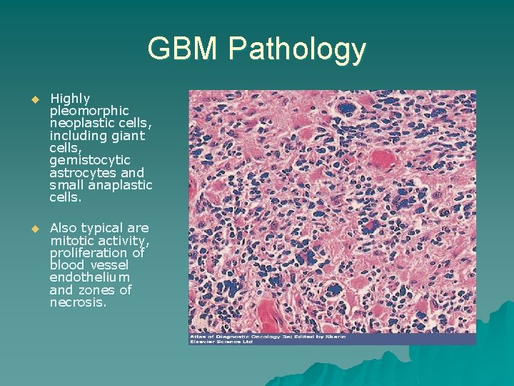 GBM Pathology u Highly pleomorphic neoplastic cells, including giant cells, gemistocytic astrocytes and small