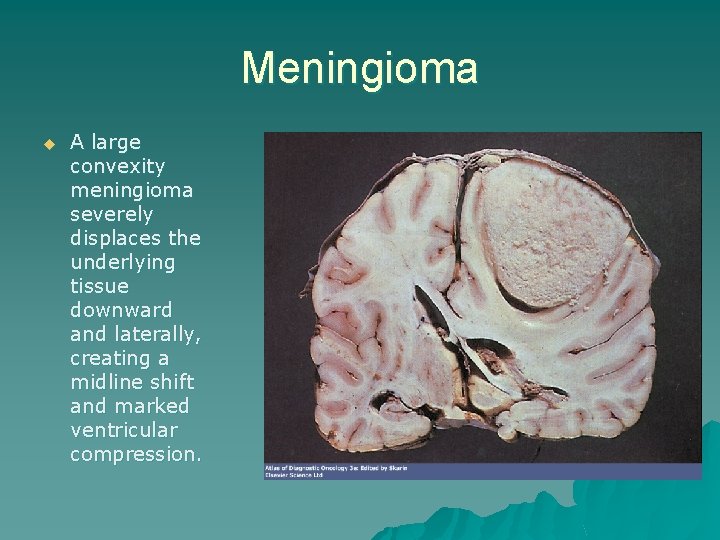 Meningioma u A large convexity meningioma severely displaces the underlying tissue downward and laterally,