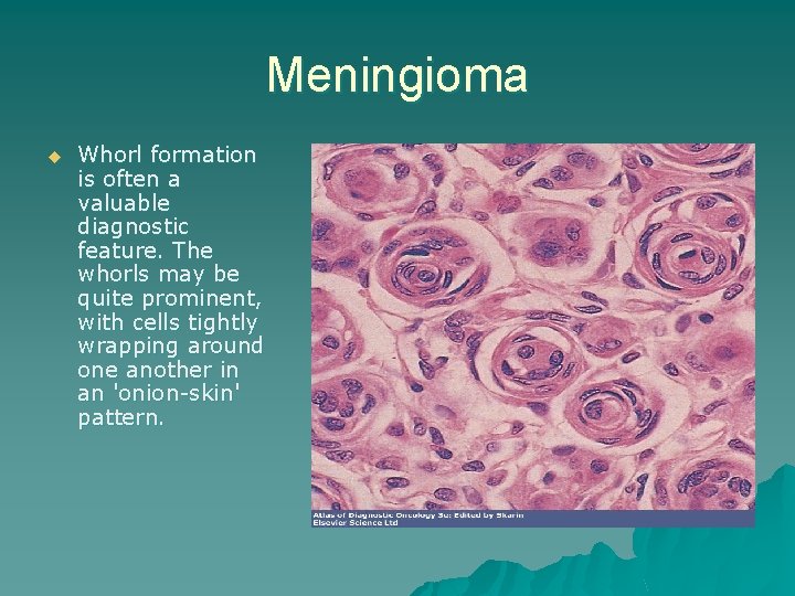 Meningioma u Whorl formation is often a valuable diagnostic feature. The whorls may be