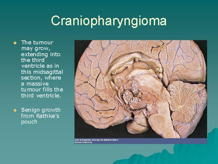 Craniopharyngioma u The tumour may grow, extending into the third ventricle as in this