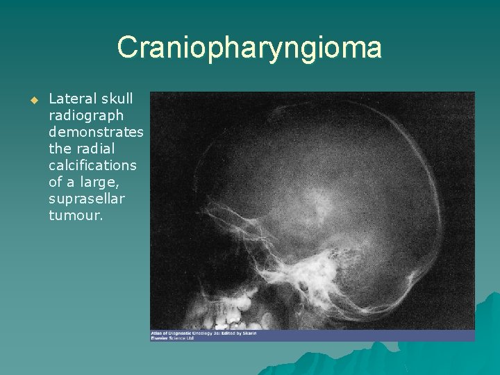 Craniopharyngioma u Lateral skull radiograph demonstrates the radial calcifications of a large, suprasellar tumour.