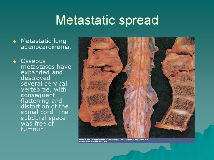 Metastatic spread u Metastatic lung adenocarcinoma. u Osseous metastases have expanded and destroyed several