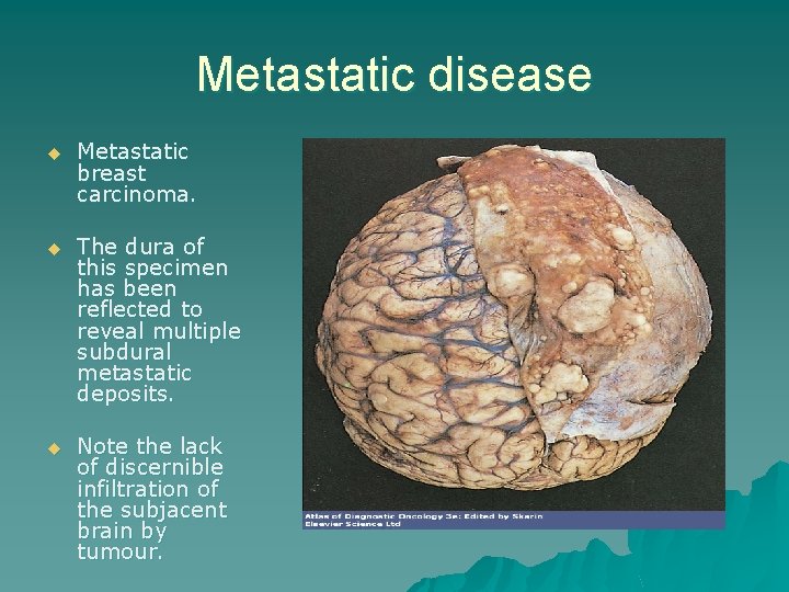 Metastatic disease u Metastatic breast carcinoma. u The dura of this specimen has been