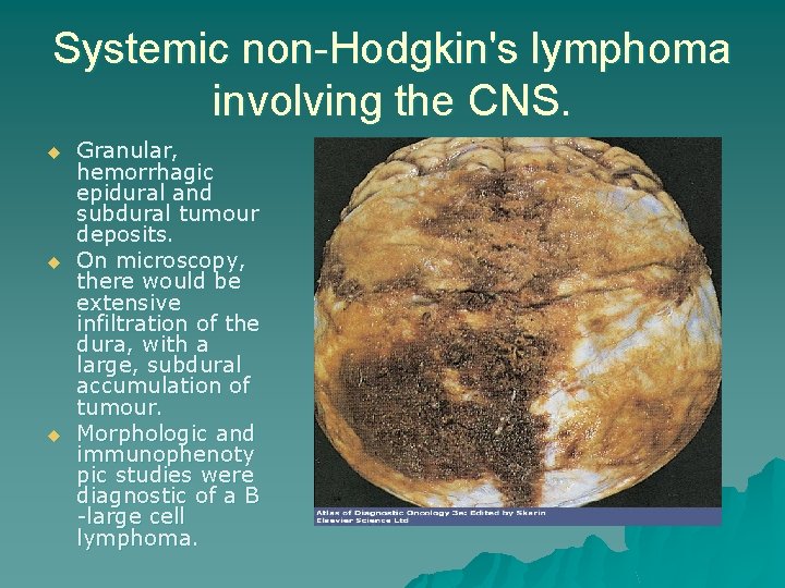 Systemic non-Hodgkin's lymphoma involving the CNS. u u u Granular, hemorrhagic epidural and subdural