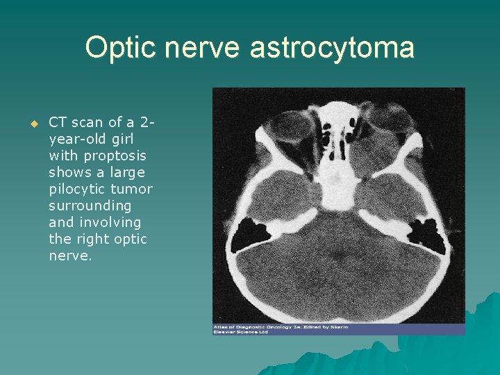 Optic nerve astrocytoma u CT scan of a 2 year-old girl with proptosis shows