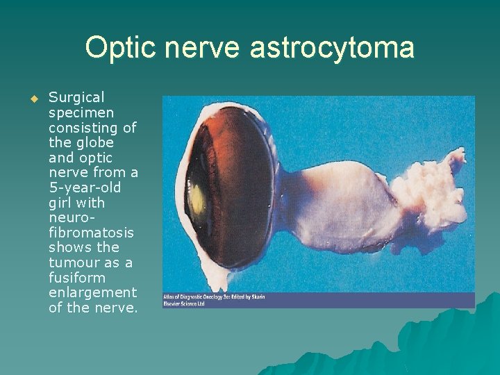 Optic nerve astrocytoma u Surgical specimen consisting of the globe and optic nerve from