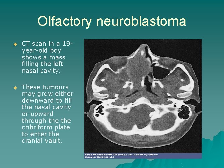 Olfactory neuroblastoma u CT scan in a 19 year-old boy shows a mass filling