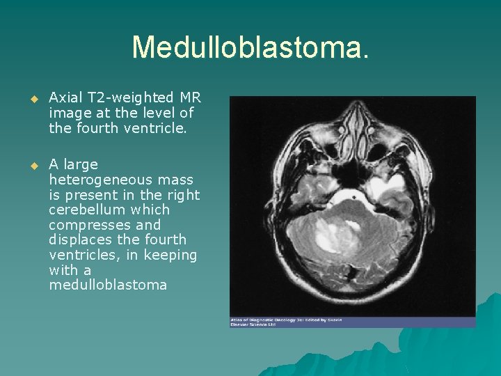 Medulloblastoma. u Axial T 2 -weighted MR image at the level of the fourth