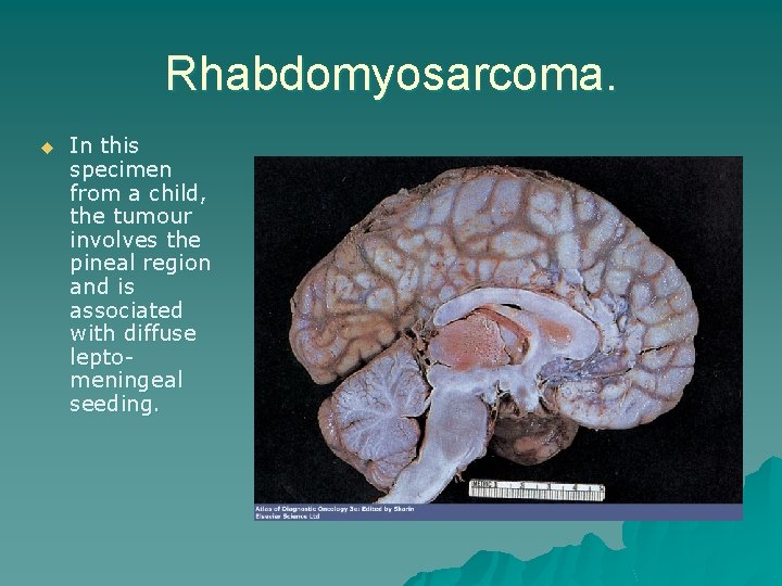 Rhabdomyosarcoma. u In this specimen from a child, the tumour involves the pineal region