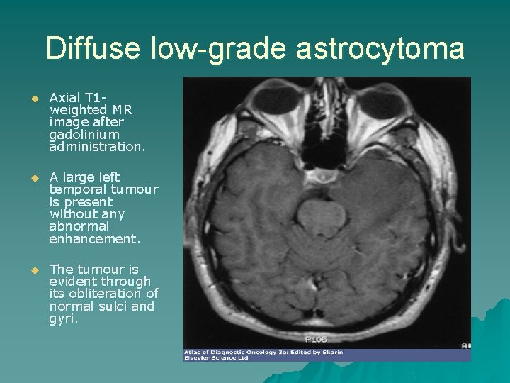 Diffuse low-grade astrocytoma u Axial T 1 weighted MR image after gadolinium administration. u