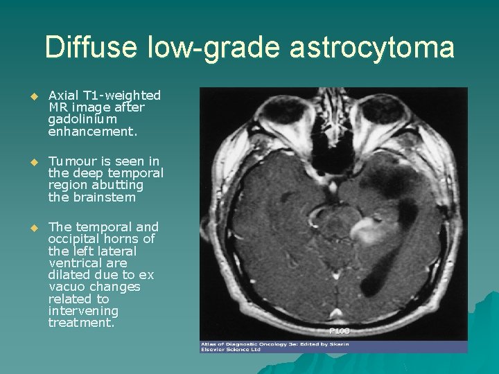 Diffuse low-grade astrocytoma u Axial T 1 -weighted MR image after gadolinium enhancement. u