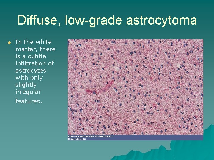 Diffuse, low-grade astrocytoma u In the white matter, there is a subtle infiltration of