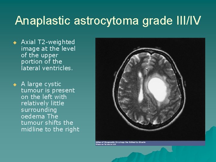 Anaplastic astrocytoma grade III/IV u Axial T 2 -weighted image at the level of