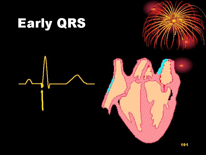 Early QRS 101 