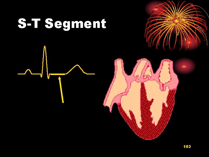 S-T Segment 103 