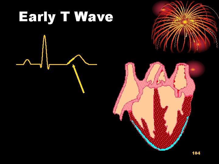 Early T Wave 104 