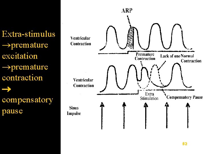 Extra-stimulus premature excitation premature contraction compensatory pause 52 