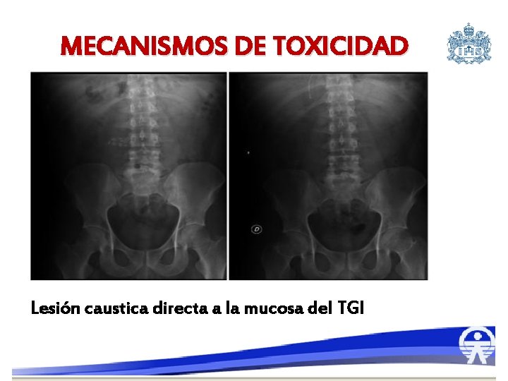 MECANISMOS DE TOXICIDAD Lesión caustica directa a la mucosa del TGI 