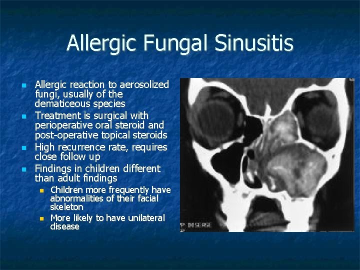 Allergic Fungal Sinusitis Allergic reaction to aerosolized fungi, usually of the dematiceous species Treatment