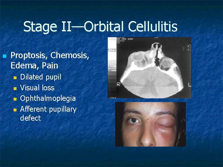 Stage II—Orbital Cellulitis Proptosis, Chemosis, Edema, Pain Dilated pupil Visual loss Ophthalmoplegia Afferent pupillary
