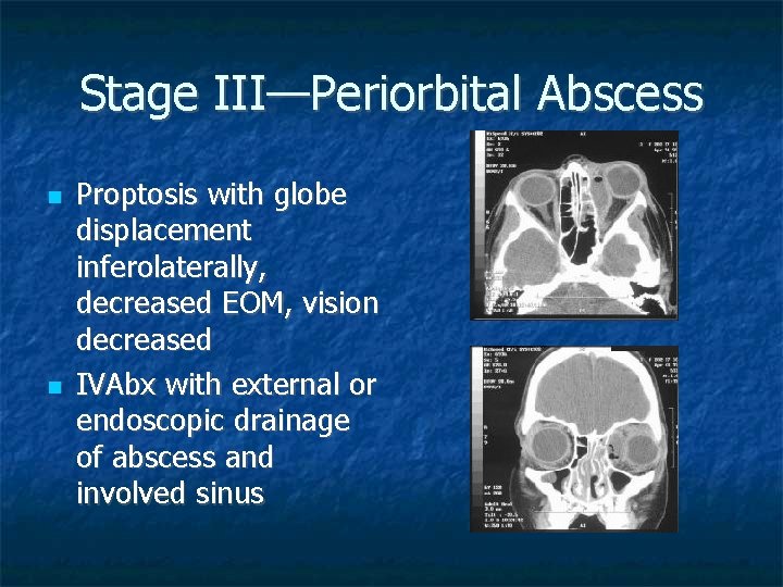 Stage III—Periorbital Abscess Proptosis with globe displacement inferolaterally, decreased EOM, vision decreased IVAbx with