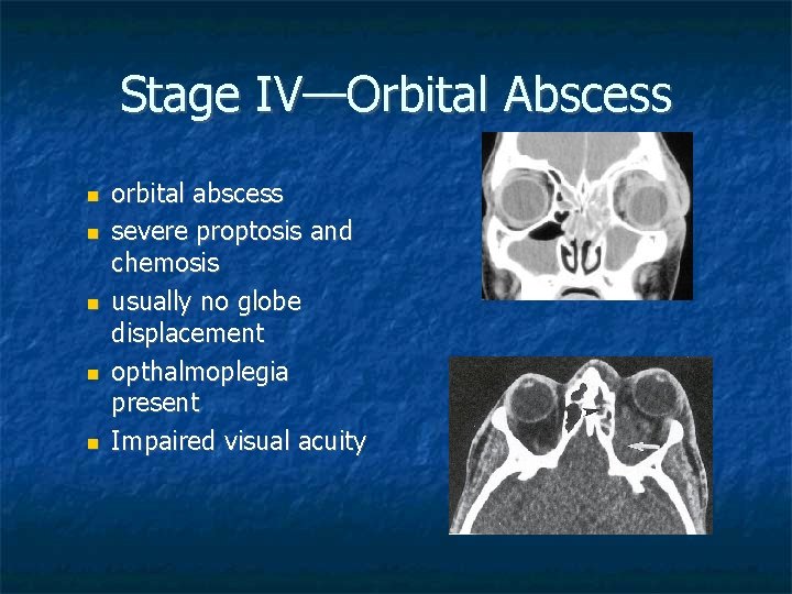 Stage IV—Orbital Abscess orbital abscess severe proptosis and chemosis usually no globe displacement opthalmoplegia