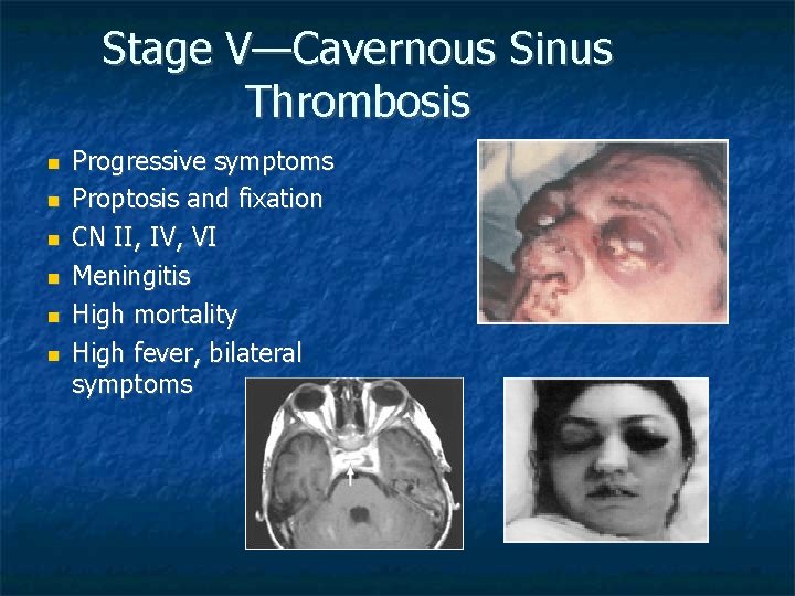 Stage V—Cavernous Sinus Thrombosis Progressive symptoms Proptosis and fixation CN II, IV, VI Meningitis