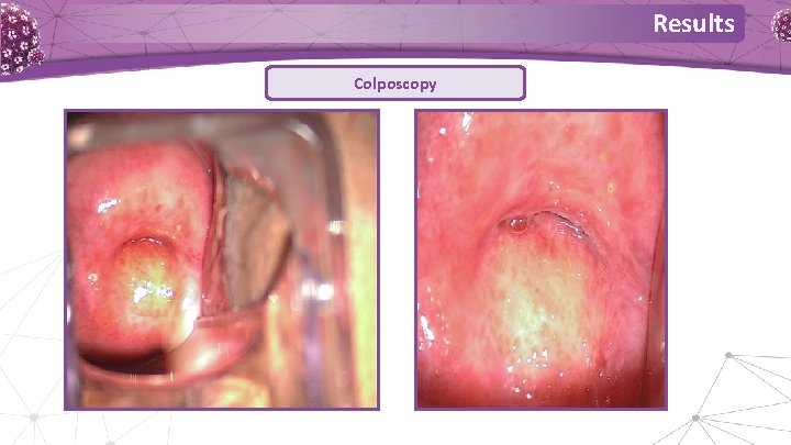 Results Colposcopy 