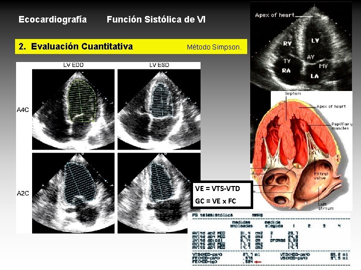 Ecocardiografía Función Sistólica de VI 2. Evaluación Cuantitativa Método Simpson. VE = VTS-VTD GC Ecocardiografía Función Sistólica de VI 2. Evaluación Cuantitativa Método Simpson. VE = VTS-VTD GC