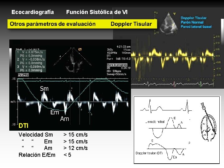 Ecocardiografía Función Sistólica de VI DTI Velocidad Sm “ “ Em “ “ Am Ecocardiografía Función Sistólica de VI DTI Velocidad Sm “ “ Em “ “ Am